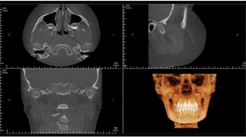 TMJ x-rays 4 images